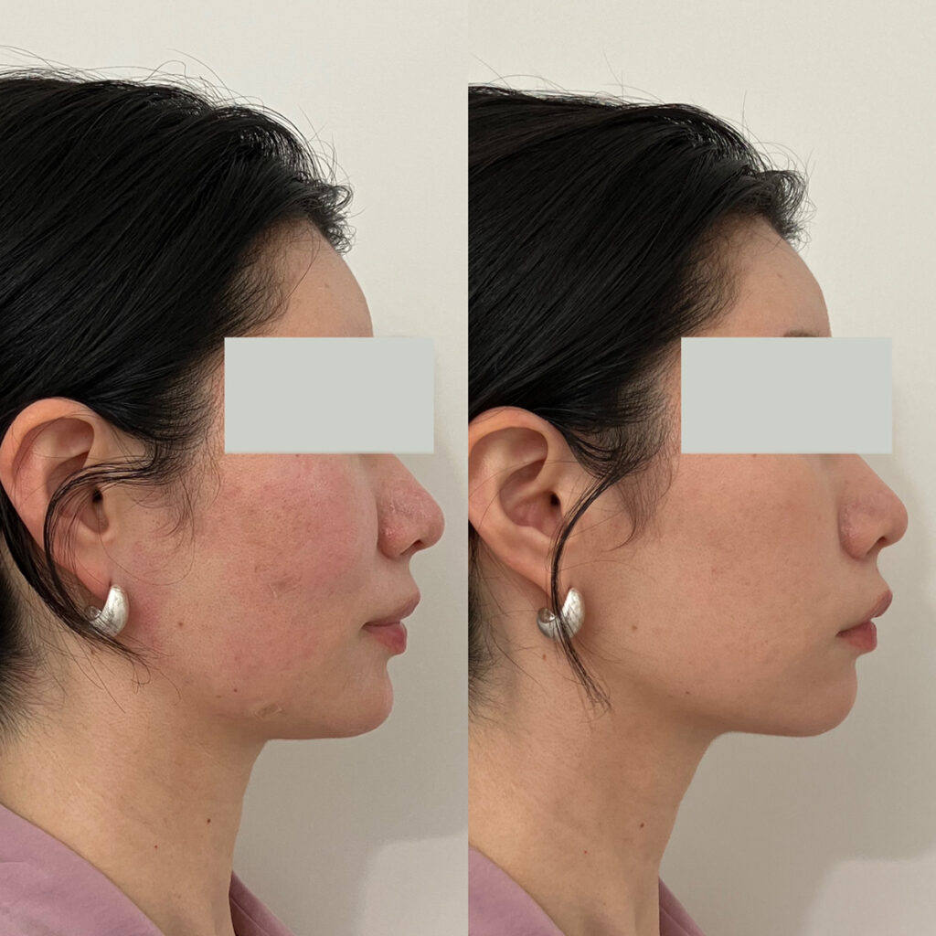 30代女性ヒアルロン酸注入(顎)の症例写真